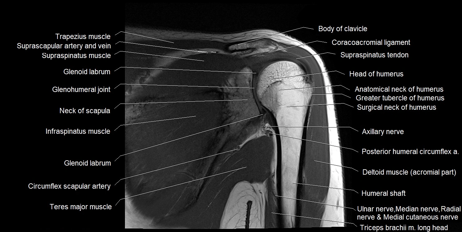 mri shoulder coronal cross sectional anatomy image 10.webp